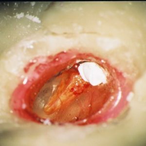 Bone 3 with Cholesteatoma