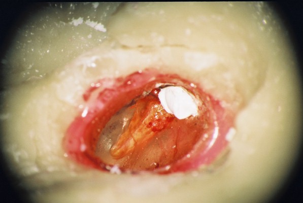 Bone 3 with cholesteatoma